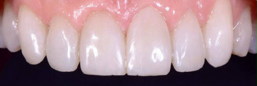 Cosmetic dentistry full mouth rehabilitation of worn down teeth after