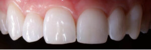 Cosmetic dentistry white spots after