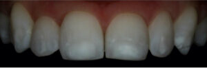 Cosmetic dentistry white spots before