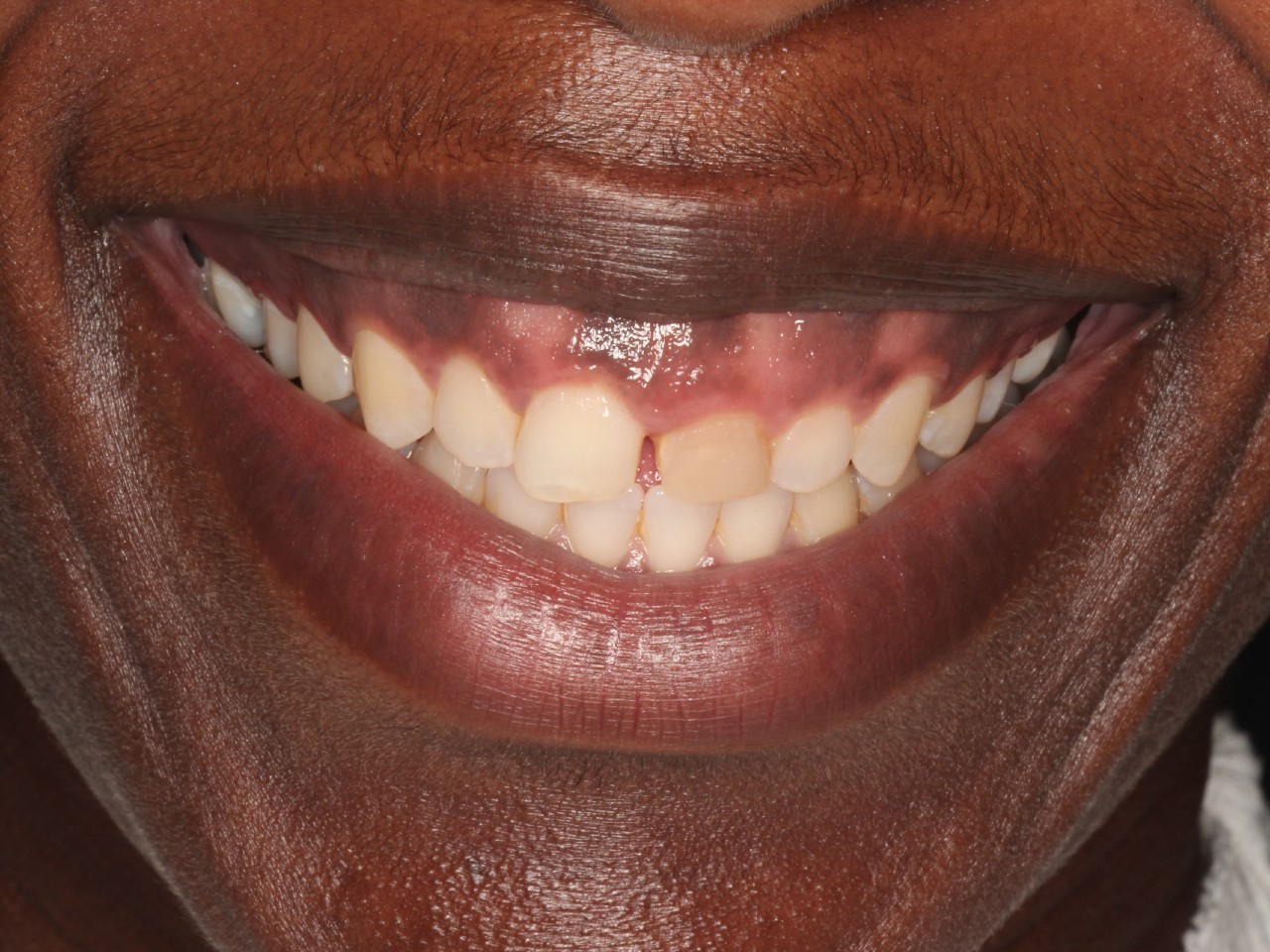 Periodontics, Gummy Smile, before
